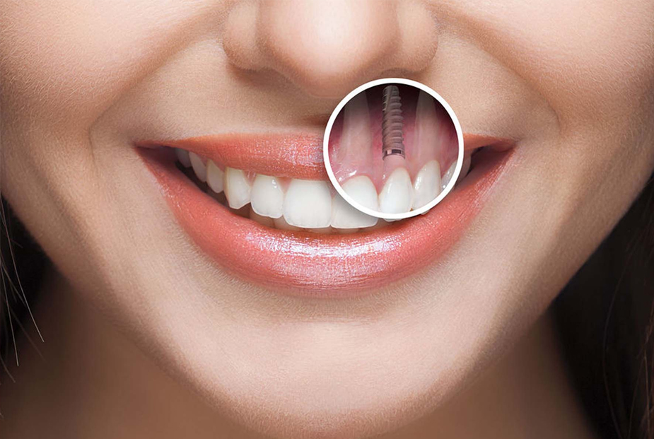 Implants