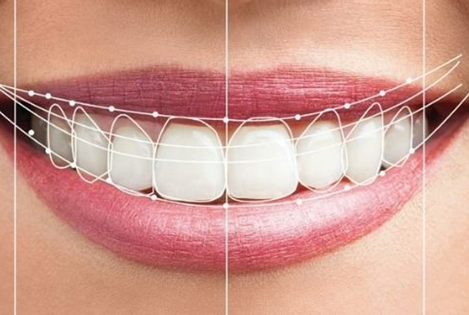 Smile Makeover